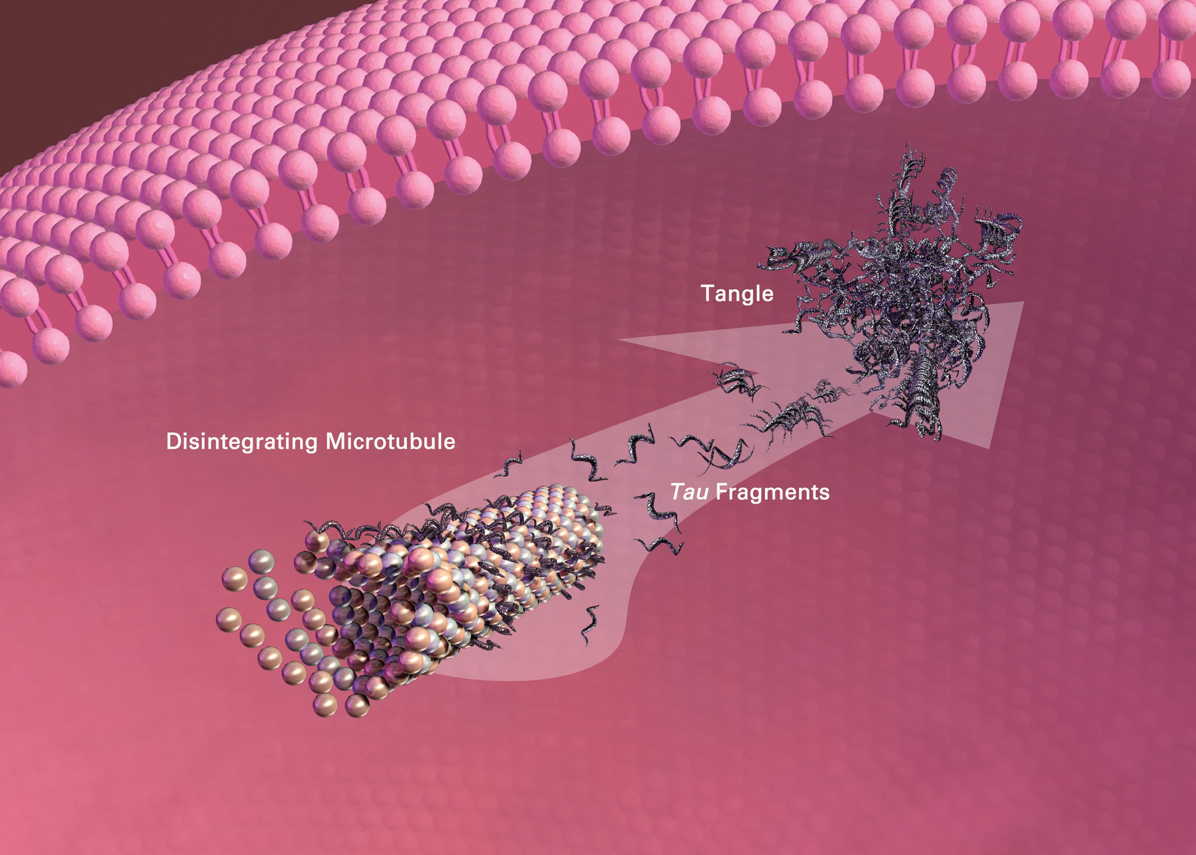 Plaques and Tangles in the Alzheimer's BrainWhich One Is Most To Blame