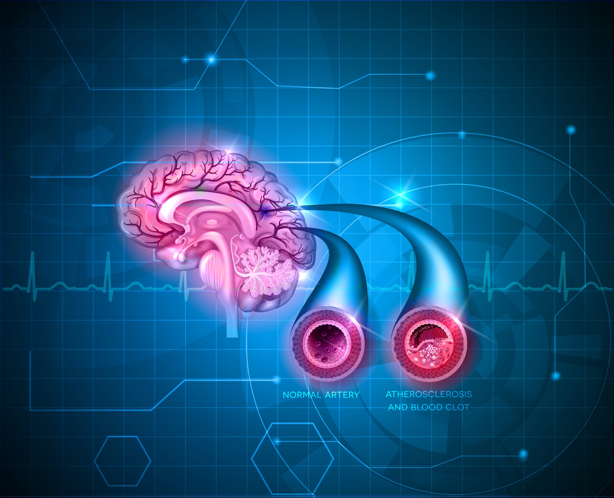 Illustration depict the normal and abnormal circulation of blood to the brain