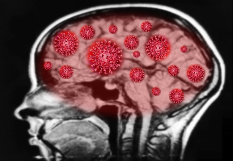 How COVID-19 might increase risk of memory loss and cognitive decline